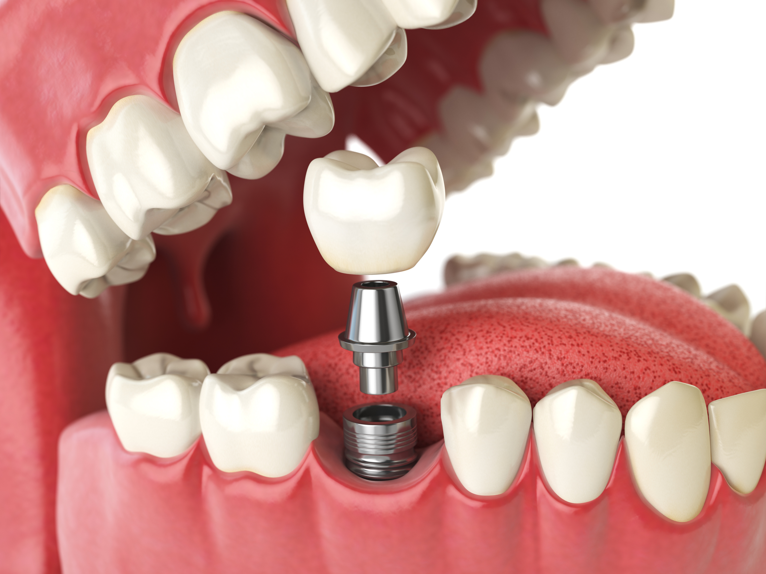 Implantat